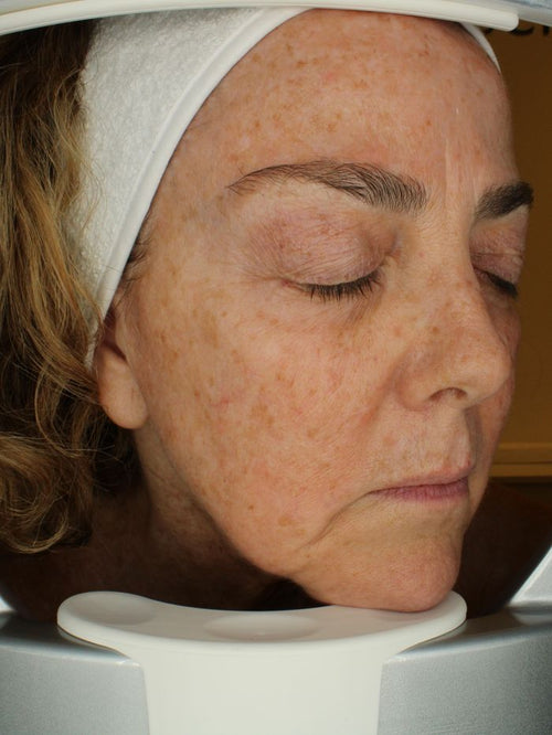After three anti-wrinkle sessions
