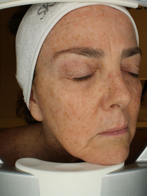 Before anti-wrinkle programme