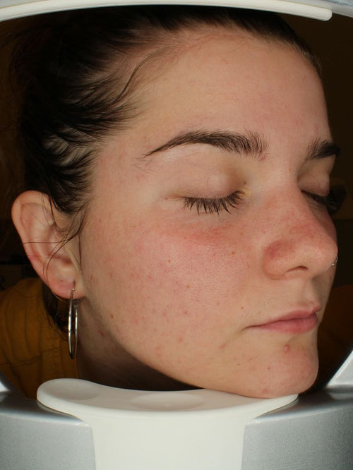 After four skin clarity sessions