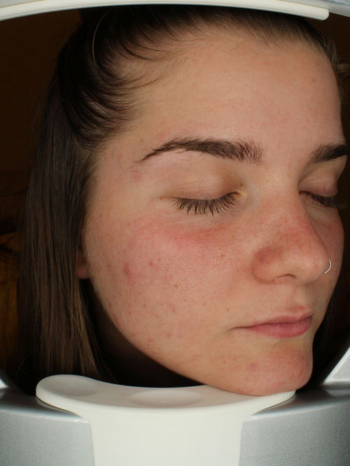 Before skin clarity programme